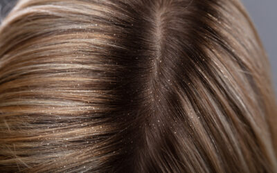 5 Easy Steps to Get Rid of a Dry Scalp